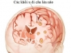 Ung thư di căn não: Có những phương pháp chữa trị nào?